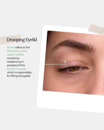 1. Instagram design - Droopy eyelid